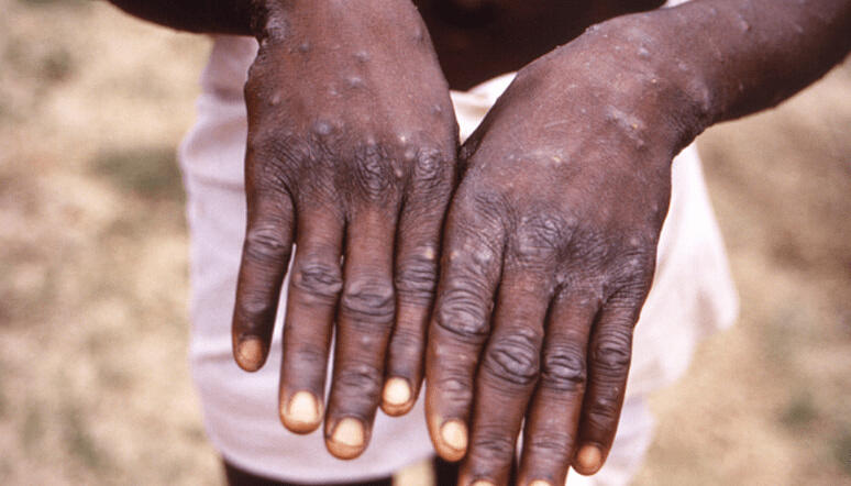 Handen Mpox